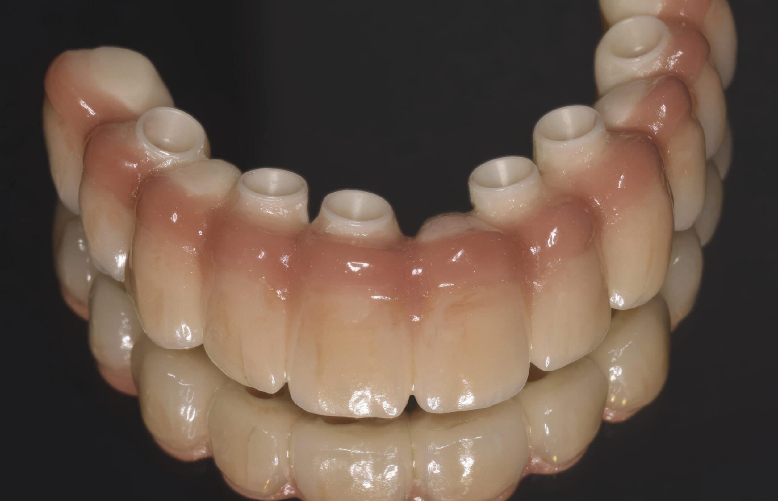 Barra implantare CAD:CAM in resina con gengiva artificiale – Protesi stabilizzata su impianti