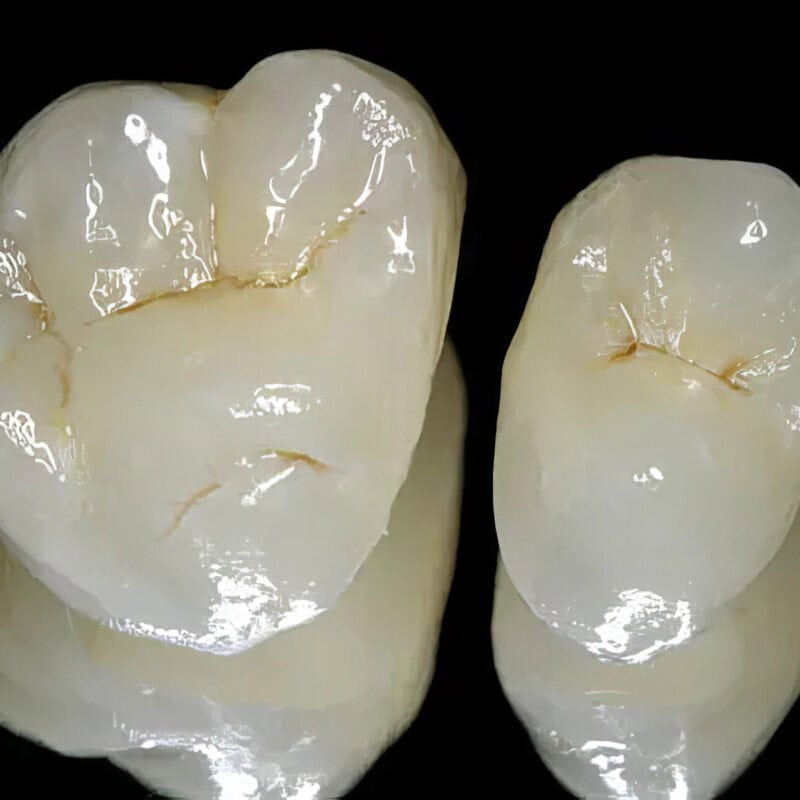 Corona E-max: Empress – Protesi dentale di alta gamma, 100% ceramica, per un restauro estetico e duraturo 2