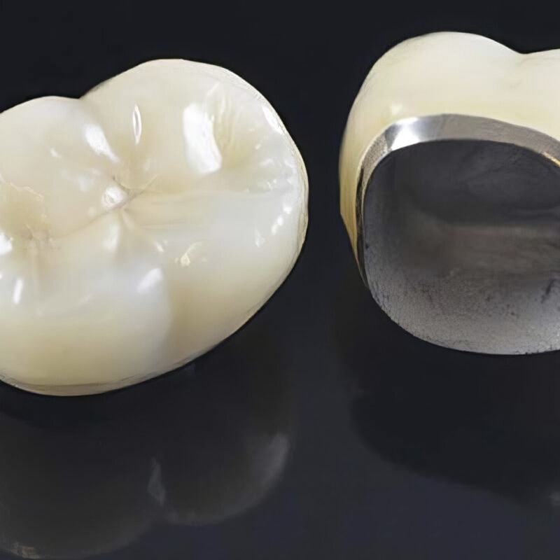 Corona ceramo-metallica (CCM) – Protesi dentale fissa che unisce resistenza ed estetica per restauri duraturi
