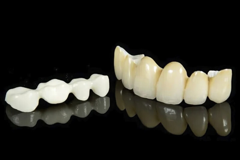 Corona in zirconia stratificata — Protesi dentale di alta gamma che combina struttura in zirconia e stratificazione ceramica per un risultato naturale e duraturo 1
