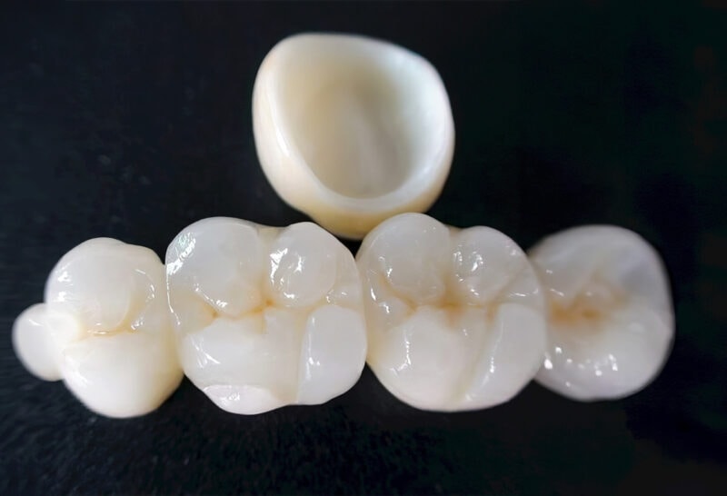 Corona in zirconia stratificata — Protesi dentale di alta gamma che combina struttura in zirconia e stratificazione ceramica per un risultato naturale e duraturo 2
