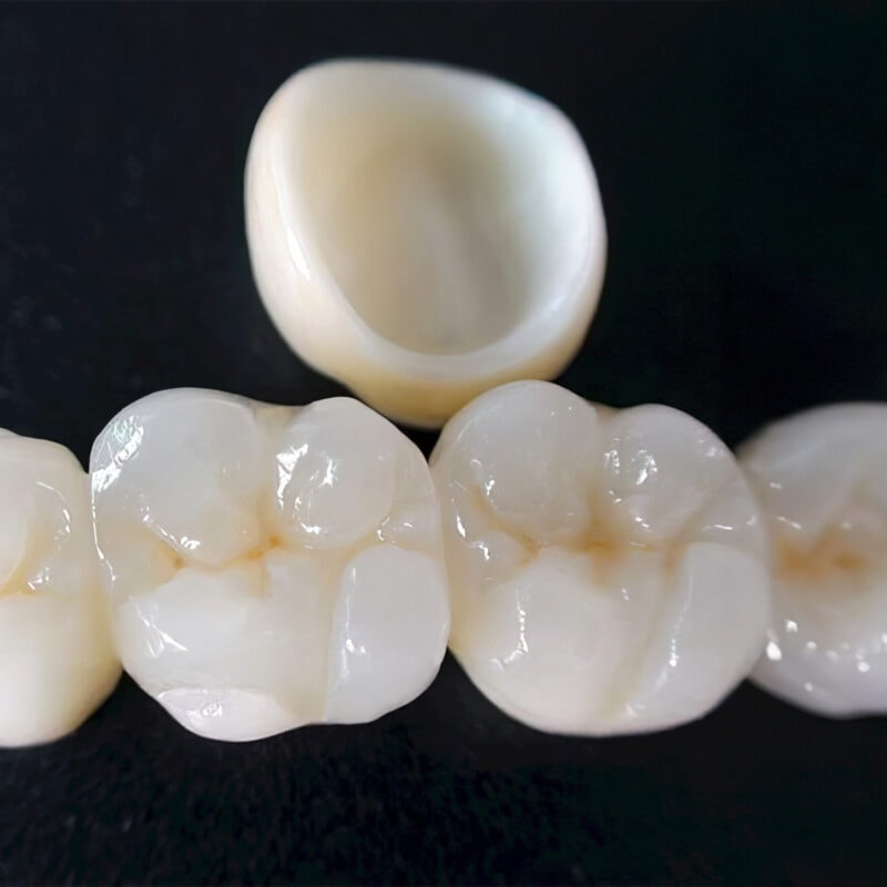 Corona in zirconia stratificata — Protesi dentale di alta gamma che combina struttura in zirconia e stratificazione ceramica per un risultato naturale e duraturo 2