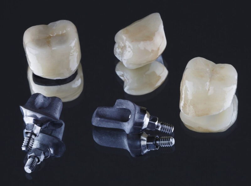 Corone dentali cementate e pilastri personalizzati per impianti – adattamento preciso e design naturale