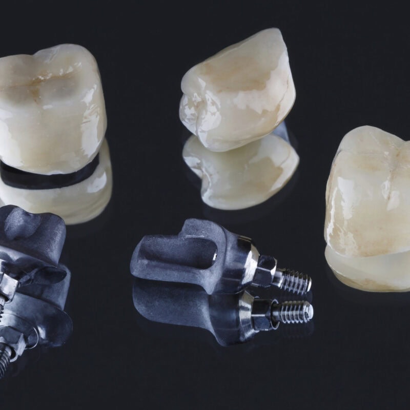 Corone dentali cementate e pilastri personalizzati per impianti – adattamento preciso e design naturale