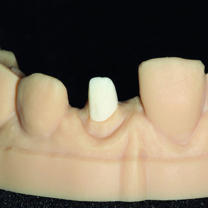 Inlay-core in fibra di vetro – Soluzione innovativa per una restaurazione dentale resistente, estetica e biocompatibile 1