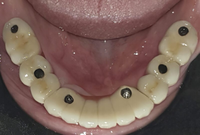 Ponte completo avvitato su impianti multi-unit – accessi occlusali visibili per un avvitamento:svitamento facilitato
