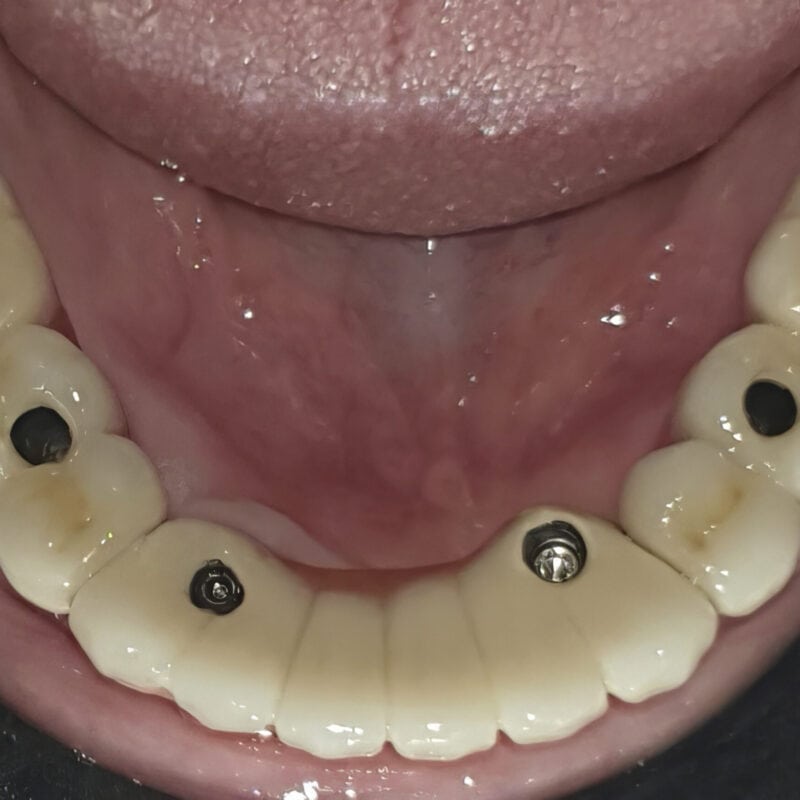 Ponte completo avvitato su impianti multi-unit – accessi occlusali visibili per un avvitamento:svitamento facilitato
